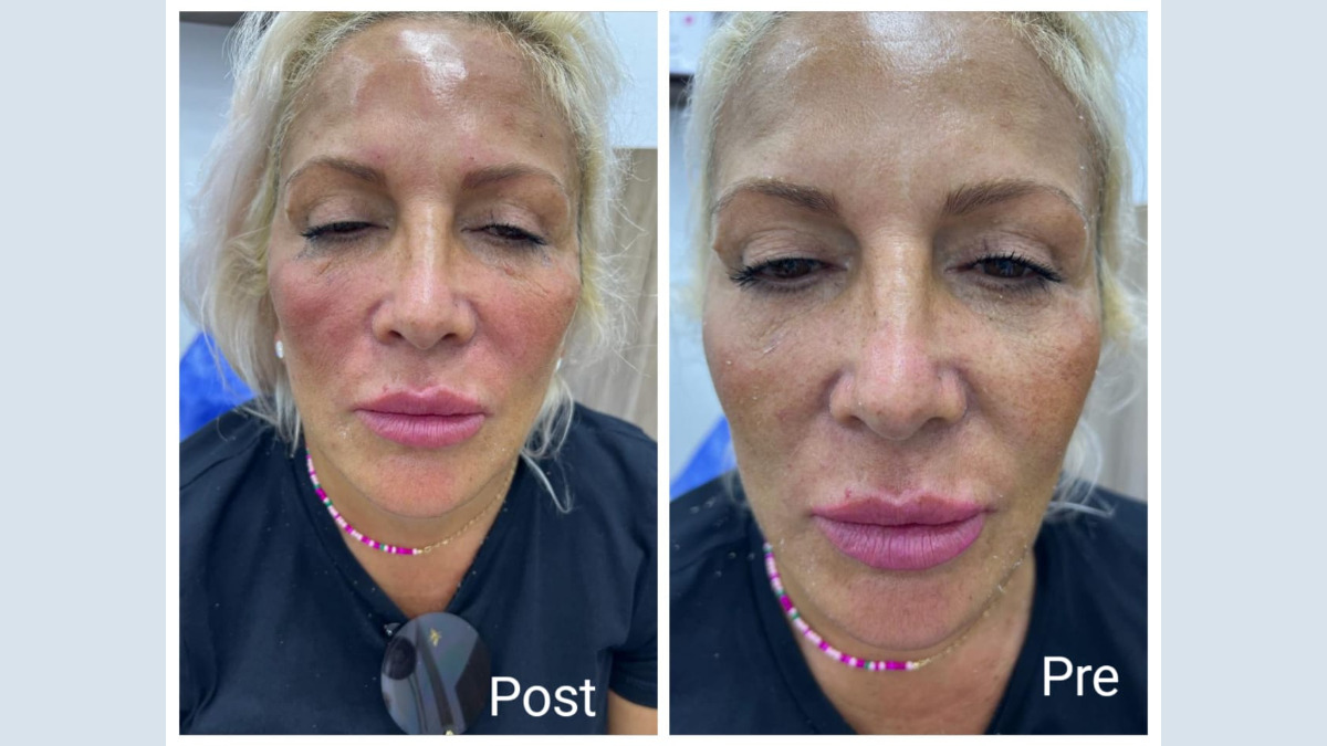 إبر نضارة للوجه في الغردقة